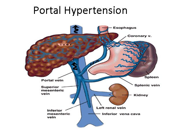 Portal Hypertension Management in Mumbai