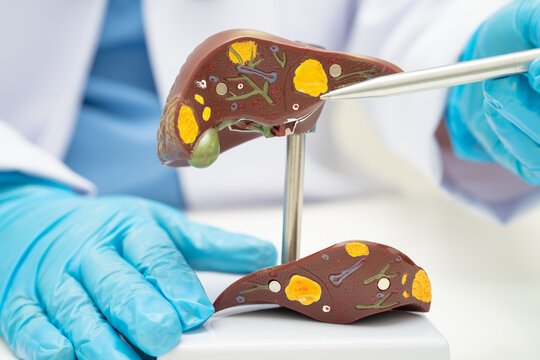 Liver Transplant