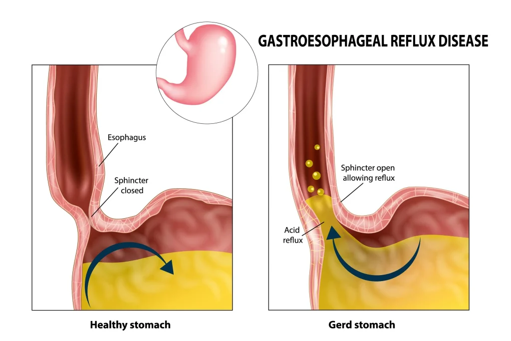 Best Doctor for GERD in Mumbai