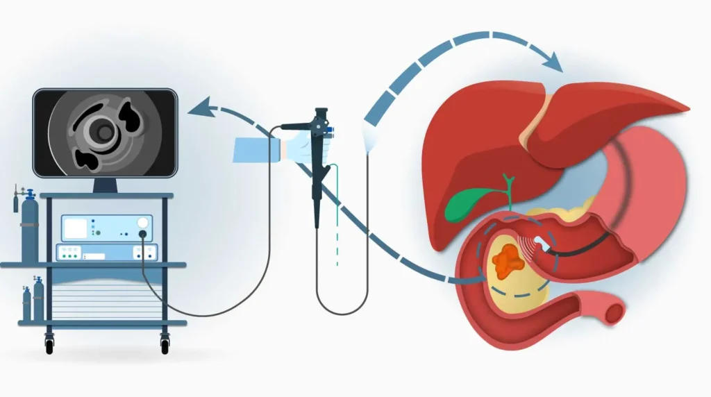 Best Endoscopic Ultrasound Procedure in Mumbai
