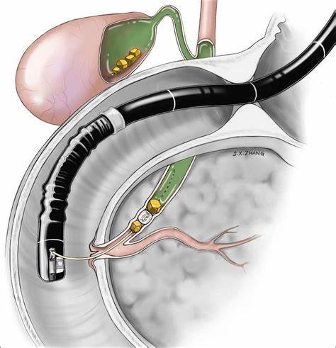 Best ERCP Treatment in Mumbai
