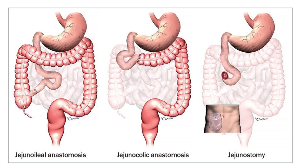 Best Treatment for Intestinal Failure in Mumbai