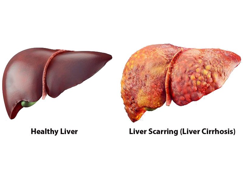 Best Treatment for Liver Cirrhosis in Mumbai