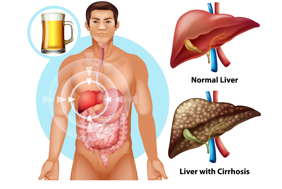 Best Doctor for Alcoholic Liver Disease in Mumbai