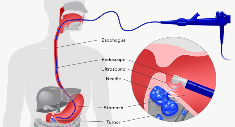 Best Endoscopic Ultrasound Procedure in Mumbai