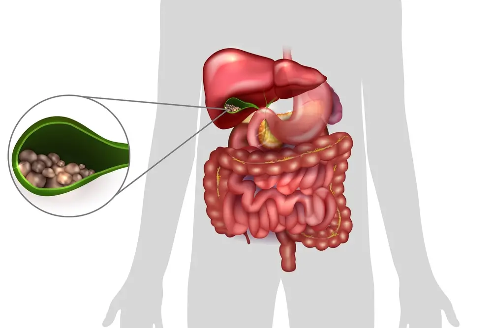 Gallbladder Stone Specialist in Mumbai