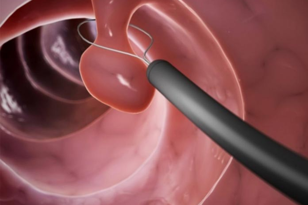 Colon Polyps