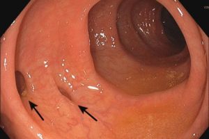 Diverticulosis