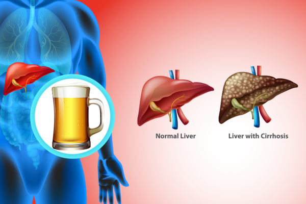 Alchoholic Liver Disease