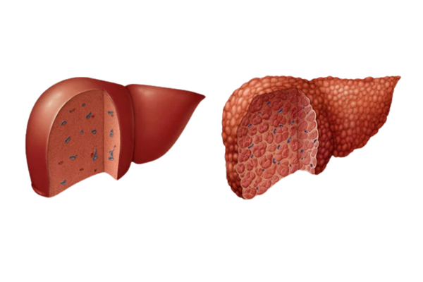 Best Liver Biopsy Procedure in Mumbai