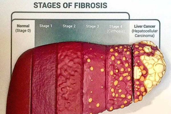 FibroScan Services in Mumbai