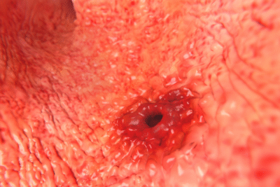 Gastric Ulcers