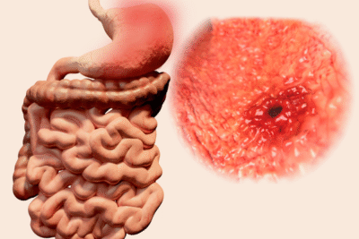 Peptic Ulcer Treatment in Mumbai