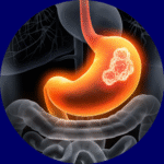 Gastric Cancer