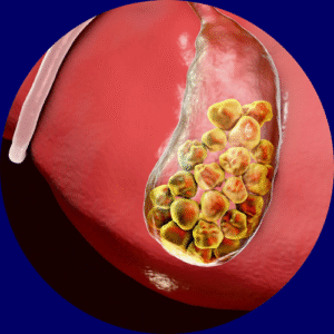 Cholecystitis