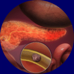 Pancreatitis