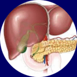 Bile duct Obstruction