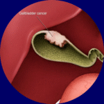 Gall bladder cancer