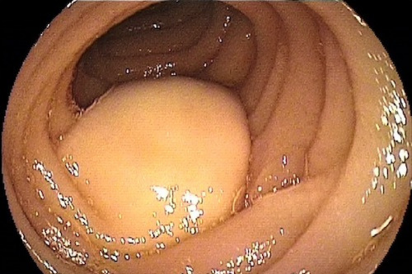 Small Tumors