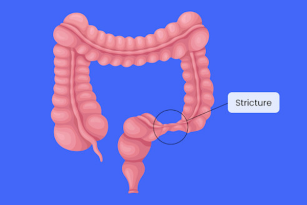 Stricture