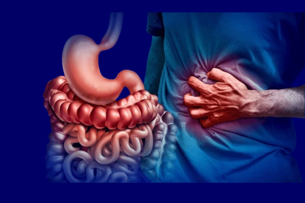 Crohns Disease