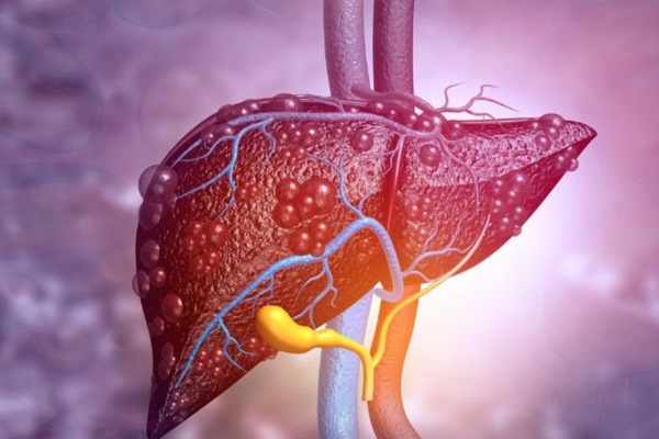 Liver Transplant