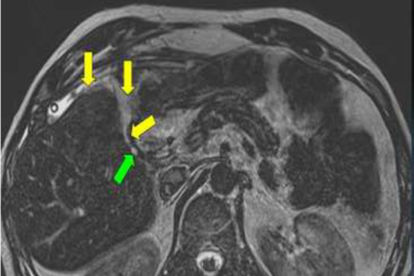 Bile Duct Injuries