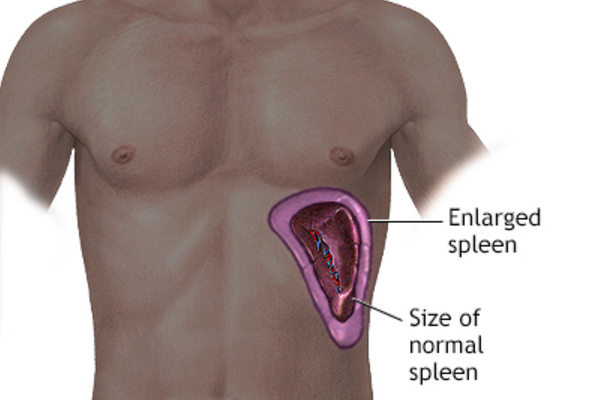 Portal Hypertension Management in Mumbai