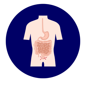 Perianal Discomfort