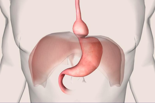 Hernia