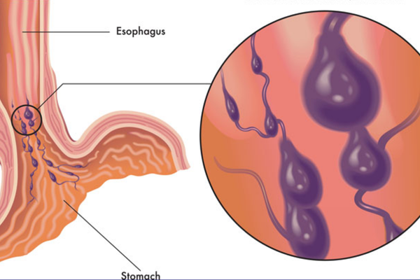 Eshophagel varices