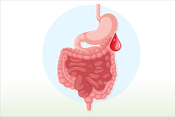 GI Bleeding