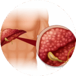 Liver Cancer