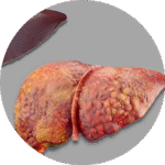 NAFLD