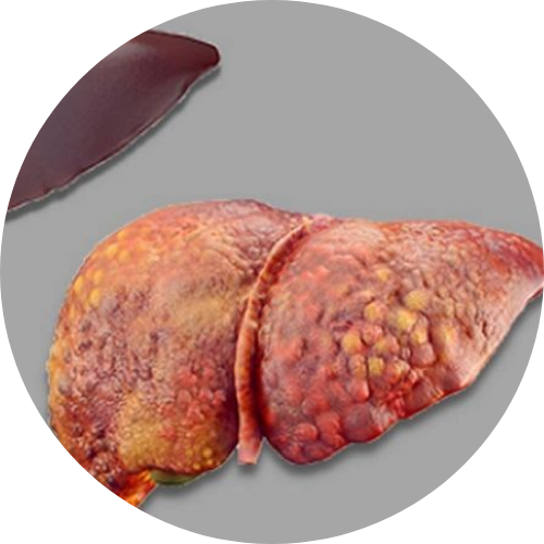 NAFLD