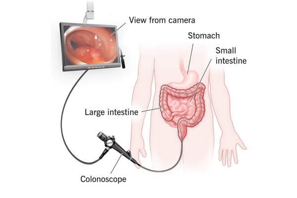 Colonoscopy Treatment in Mumbai