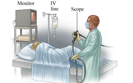 Sigmoidoscopy Procedure in Mumbai