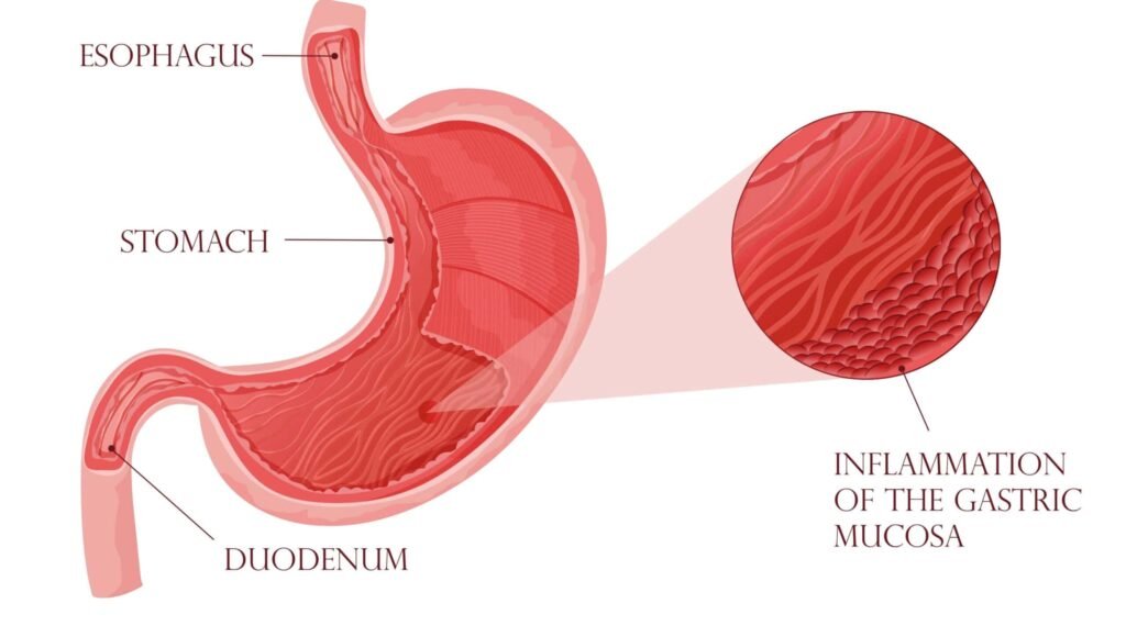 Gastritis