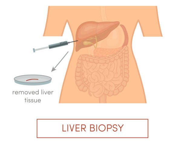 Best Liver Biopsy Procedure in Mumbai