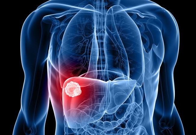 Liver Transplant