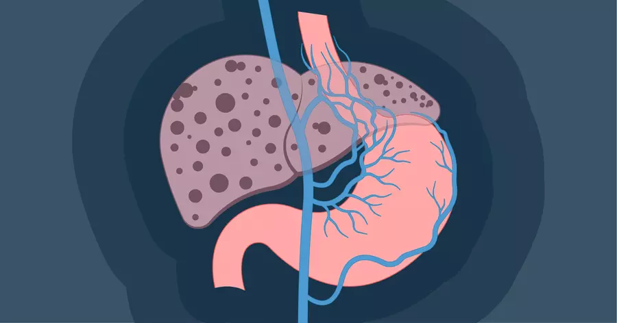 Portal Hypertension Management in Mumbai