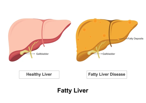 Best Treatment for Fatty Liver in Mumbai