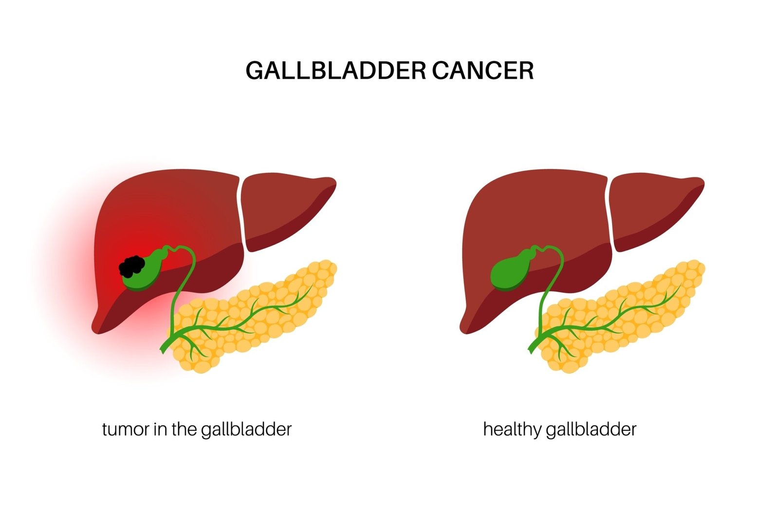 Gallbladder Cancer Treatment in Mumbai