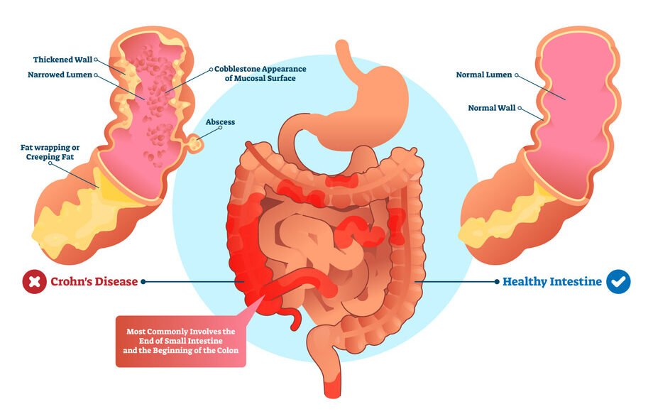 Treatment for Crohn's Disease in Mumbai