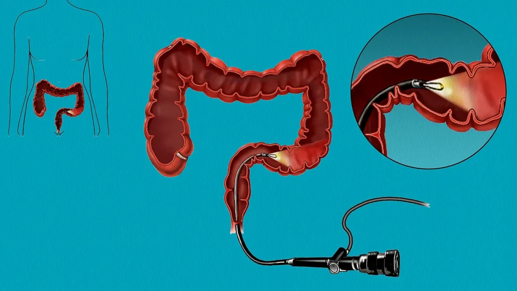Sigmoidoscopy Procedure in Mumbai