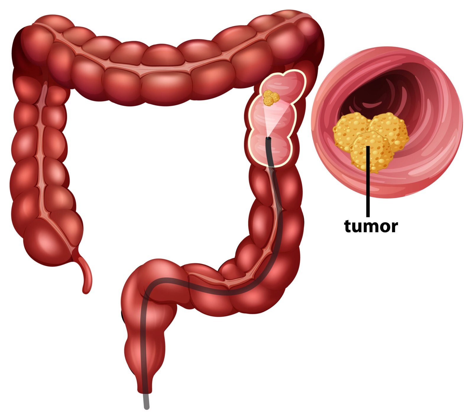 Best Treatment for Colon Cancer in Mumbai