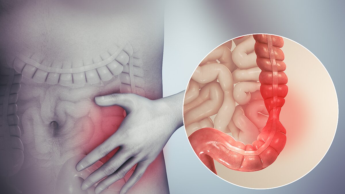 IBS Specialist Doctor in Mumbai