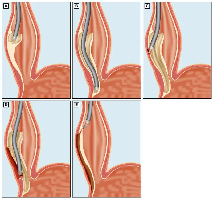 Peroral Endoscopic Myotomy (POEM) Procedure in Mumbai