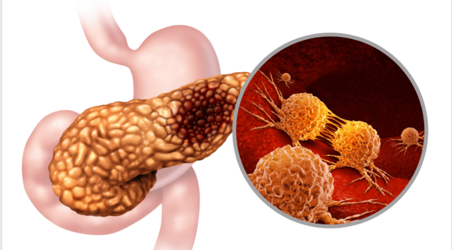 Treatment for Pancreatic Cancer in Mumbai