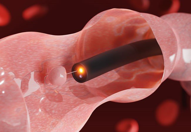 Polypectomy Surgery in Mumbai